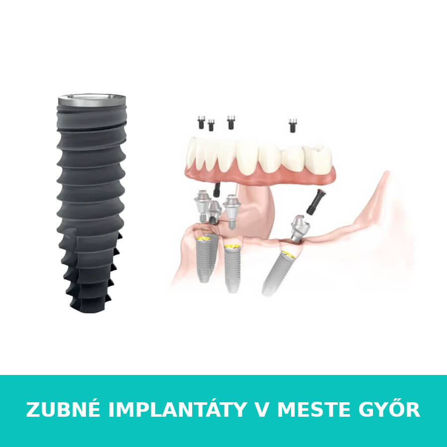 zubné implantáty